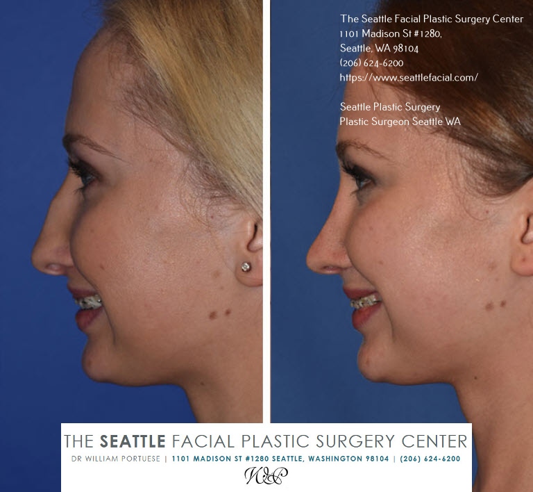 revision rhinoplasty success rate